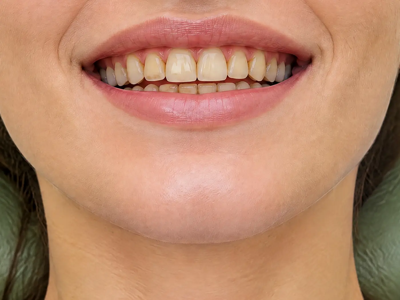 Stained teeth with tartar before cleaning